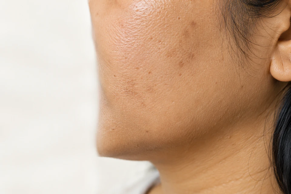 Close view of natural cheek texture and subtle uneven pigmentation